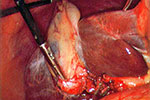 The liver (dark red shiny organ) usually lies on top of the gall bladder (white fatty looking organ)