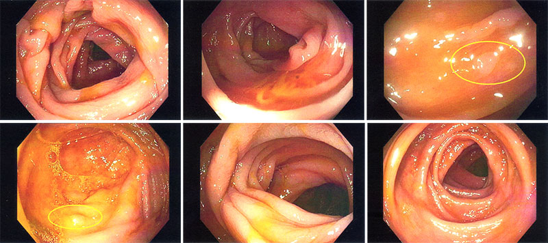 Colonoscopy images