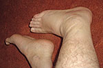 The swelling of my right foot