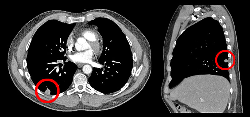 Neil the Nodule, CAT Scan, July 7, 2014