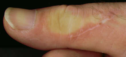 Scar on thumb